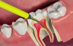 Может ли болеть зуб с удаленным нервом