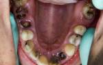 Лечение зубов без анестезии