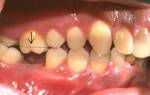 Может ли выпасть коренной зуб