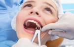 Что надо делать после удаления зуба