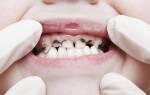 Альтернатива серебрению зубов у детей