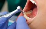 Как прочищают каналы в зубе