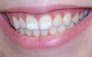Белые полоски на зубах у ребенка