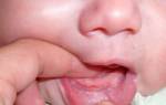 Белая точка во рту у грудничка