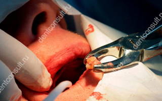 Вырывание зуба