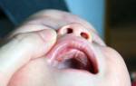 Белые пятна на языке у младенца
