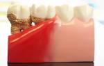 Лечение пародонтоза в стоматологии