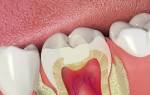 Сколько может стоять временная пломба на зубе