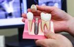 Почему не приживается имплант зуба