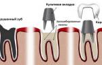 Культевые вкладки в стоматологии