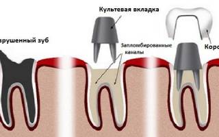 Что такое культевая вкладка в стоматологии