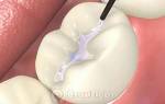 Защита зубов от кариеса