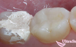 Действие мышьяка на зубной нерв