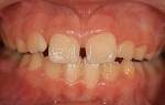 Какие зубы режутся больнее всего у детей