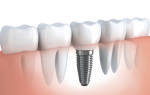 Имплант после удаления зуба через сколько времени