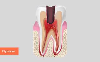 Как долго болит зуб после лечения пульпита