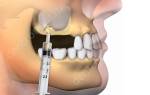 Что такое синус лифтинг в стоматологии
