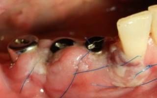 Имплантация зубов осложнения в послеоперационный период