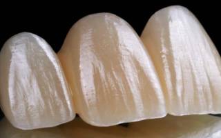Имплантация зубов верхней челюсти