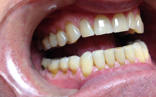 Клиновидный дефект зубов причины