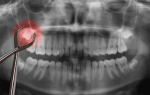Удаление зуба мудрости на верхней челюсти последствия