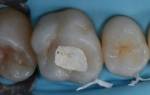Пломба на зуб цементная