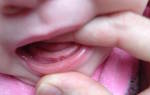 Могут ли вылезти зубы в 3 месяца