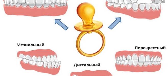 Неправильный прикус у детей