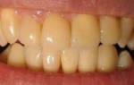 Почему желтеют зубы у ребенка
