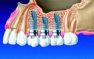 Зубные импланты как их ставят