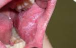Лейкоплакия полости рта лечение в домашних условиях
