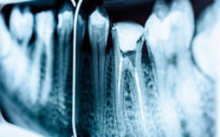 Гранулема на корне зуба лечение