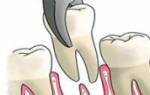 Установка импланта сразу после удаления зуба