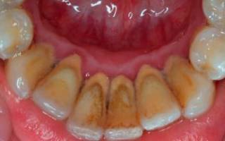 Средство для удаления зубного камня