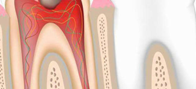 Обострение хронического пульпита