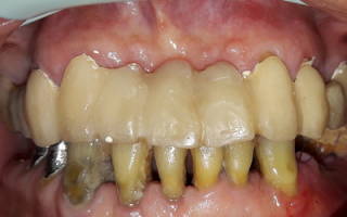 Выпал зубной мост что делать