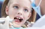 Флюороз зубов у детей лечение