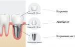 Срок годности имплантов зубов