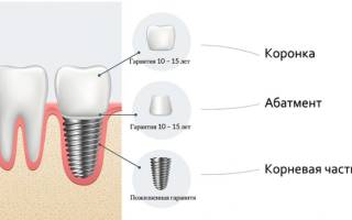 Имплантация зубов срок службы