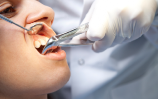 Что такое сложное удаление зуба