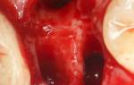 Гигиена полости рта после удаления зуба