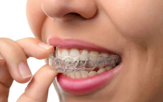 Выравнивание зубов без брекетов у взрослых