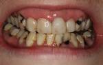 Методы лечения кариеса зубов