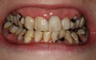 Методы лечения кариеса зубов