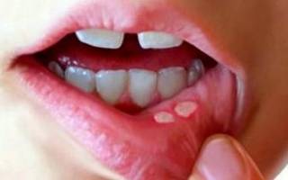 Стоматит на губе у ребенка чем лечить