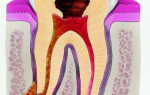 На корне зуба гранулема