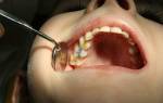 Сколько дней держать мышьяк в зубе