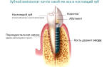 Имплантация зубов этапы установки