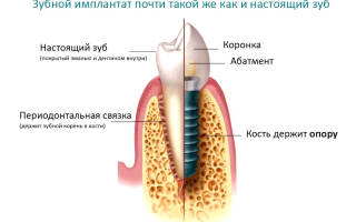 Как устанавливают имплант зубной