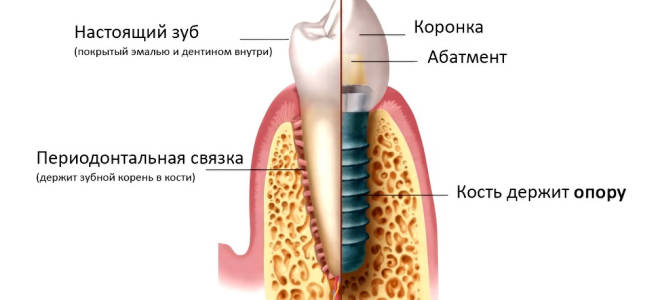 Имплантация зубов этапы установки